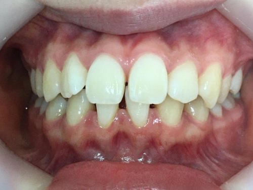 インビザライン治療 症例