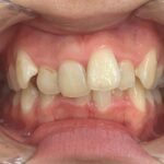 インビザラインＧO治療　症例