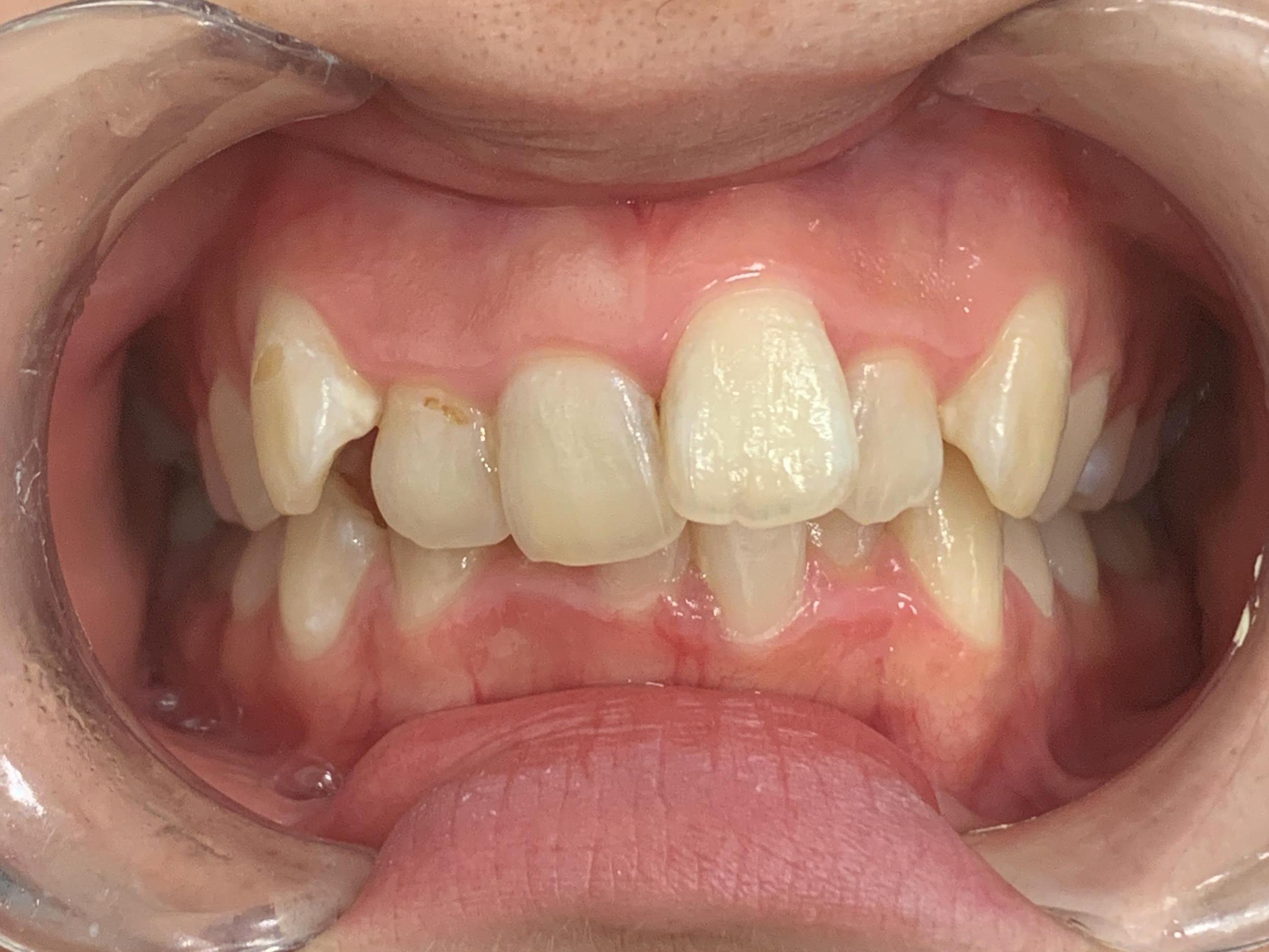 インビザラインGO治療 症例