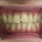 インビザライン治療　症例
