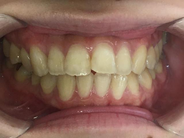 インビザライン治療 症例