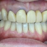 インビザラインＧO治療　症例