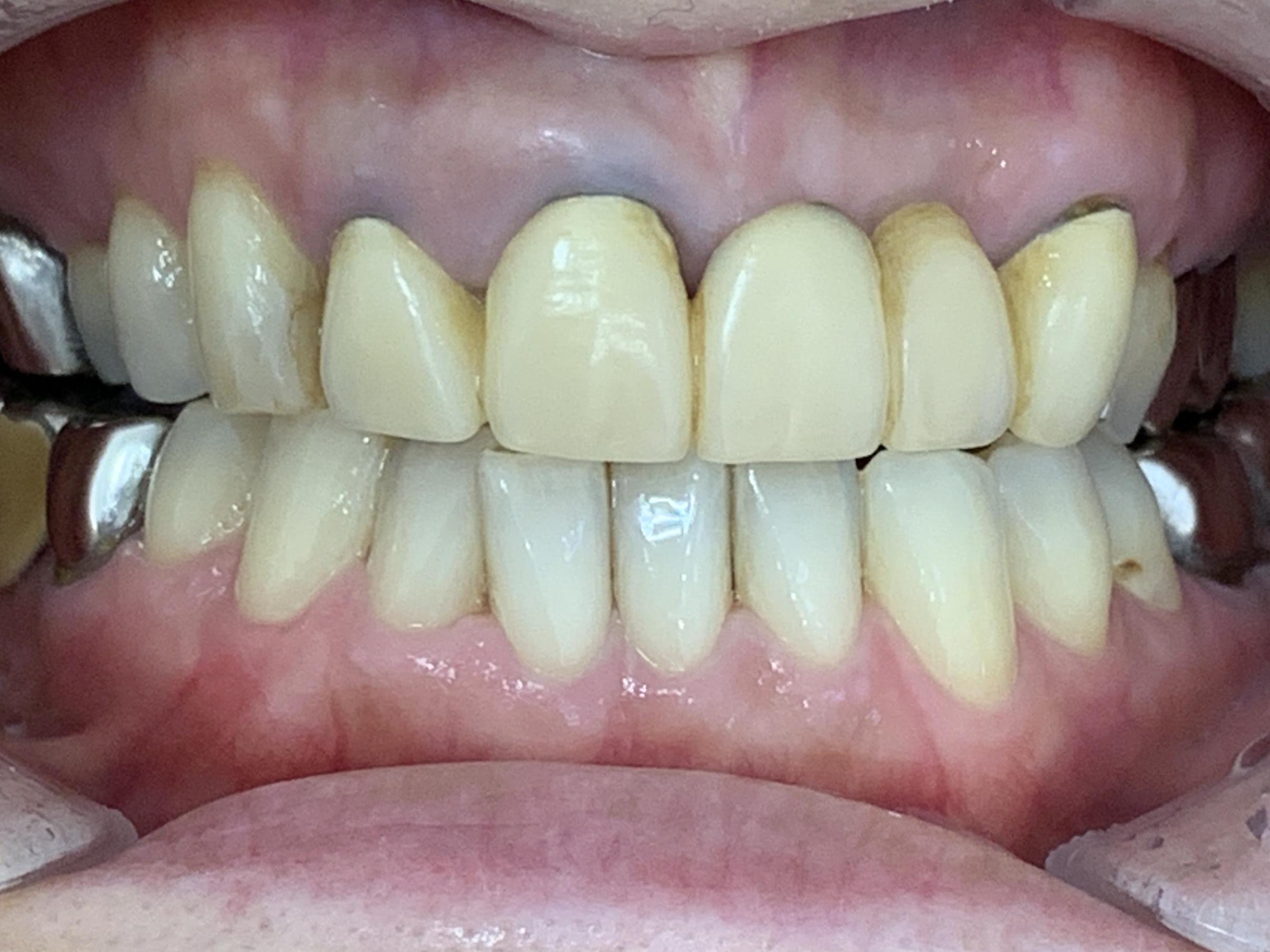 インビザラインGO治療 症例