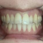 インビザラインＧO治療　症例