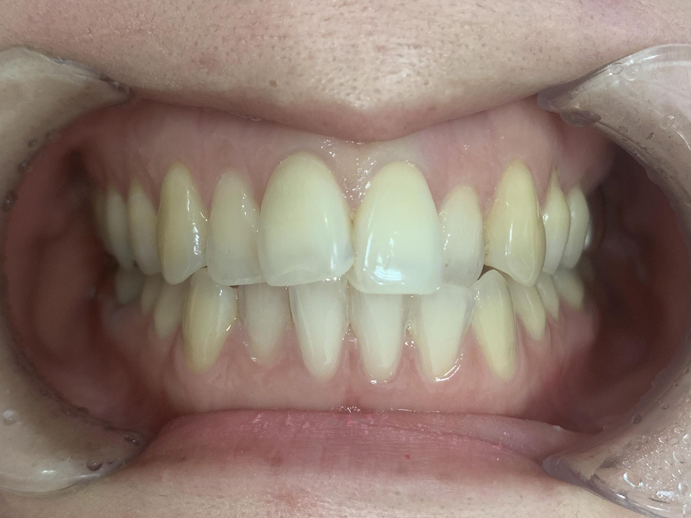 インビザラインGO治療 症例