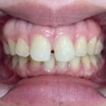 インビザラインＧO治療　症例