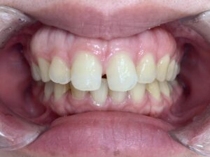 インビザラインＧO治療　症例