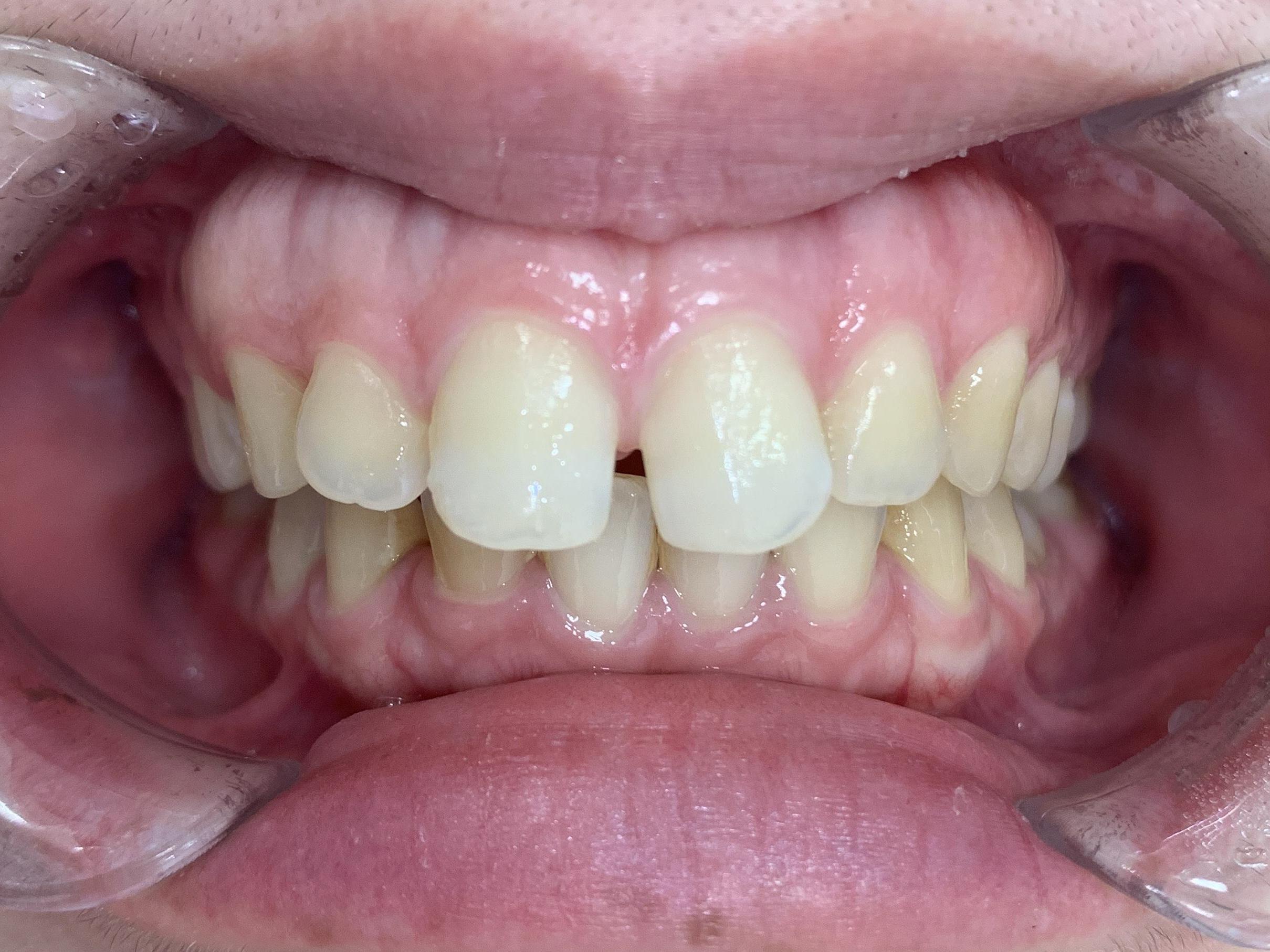 インビザラインＧO治療　症例