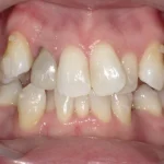 ホワイトニング　症例