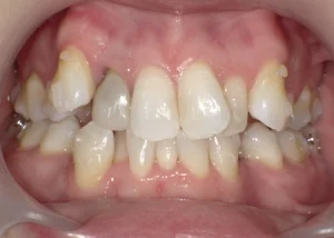 ホワイトニング　症例