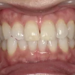 ホワイトニング　症例