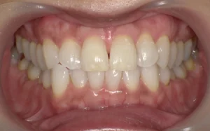 ホワイトニング　症例