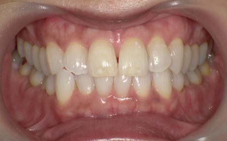 ホワイトニング 症例