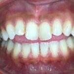 インビザライン治療　症例