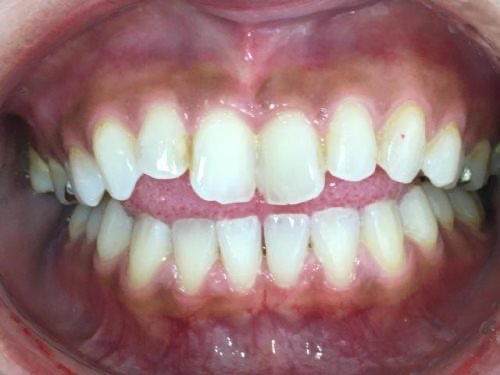 インビザライン治療 症例