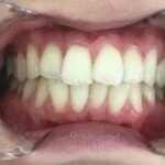 インビザライン治療　症例