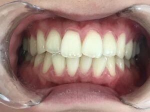 インビザライン治療　症例