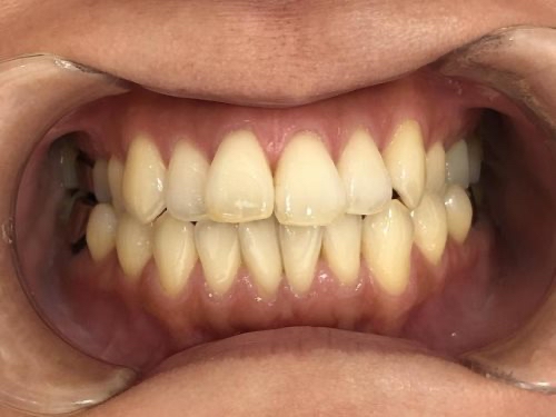 インビザライン治療 症例