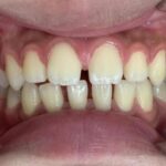 インビザライン治療　症例