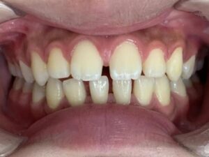 インビザライン治療　症例