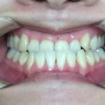 インビザライン治療　症例