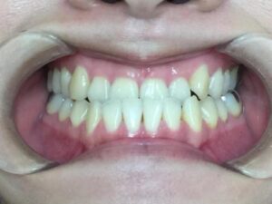 インビザライン治療　症例