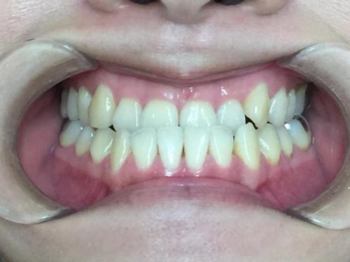 インビザライン治療 症例