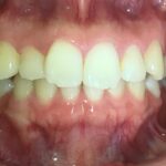 インビザラインＧO治療　症例