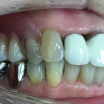 義歯　症例