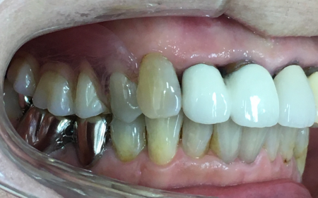 義歯　症例