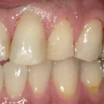 被せもの　症例