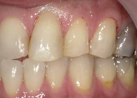 被せもの　症例