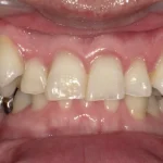 ホワイトニング　症例