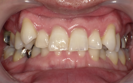 ホワイトニング 症例