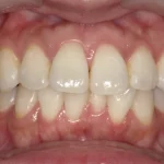 ホワイトニング　症例
