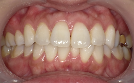 ホワイトニング 症例