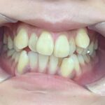 インビザライン治療　症例