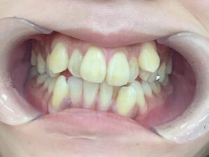 インビザライン治療　症例