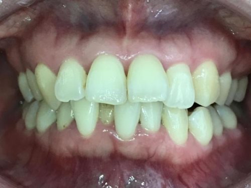 インビザライン治療 症例