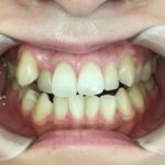 インビザライン治療　症例