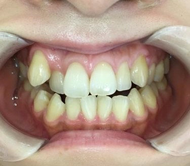インビザライン治療 症例
