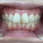 インビザラインＧO治療　症例