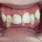 インビザラインＧO治療　症例