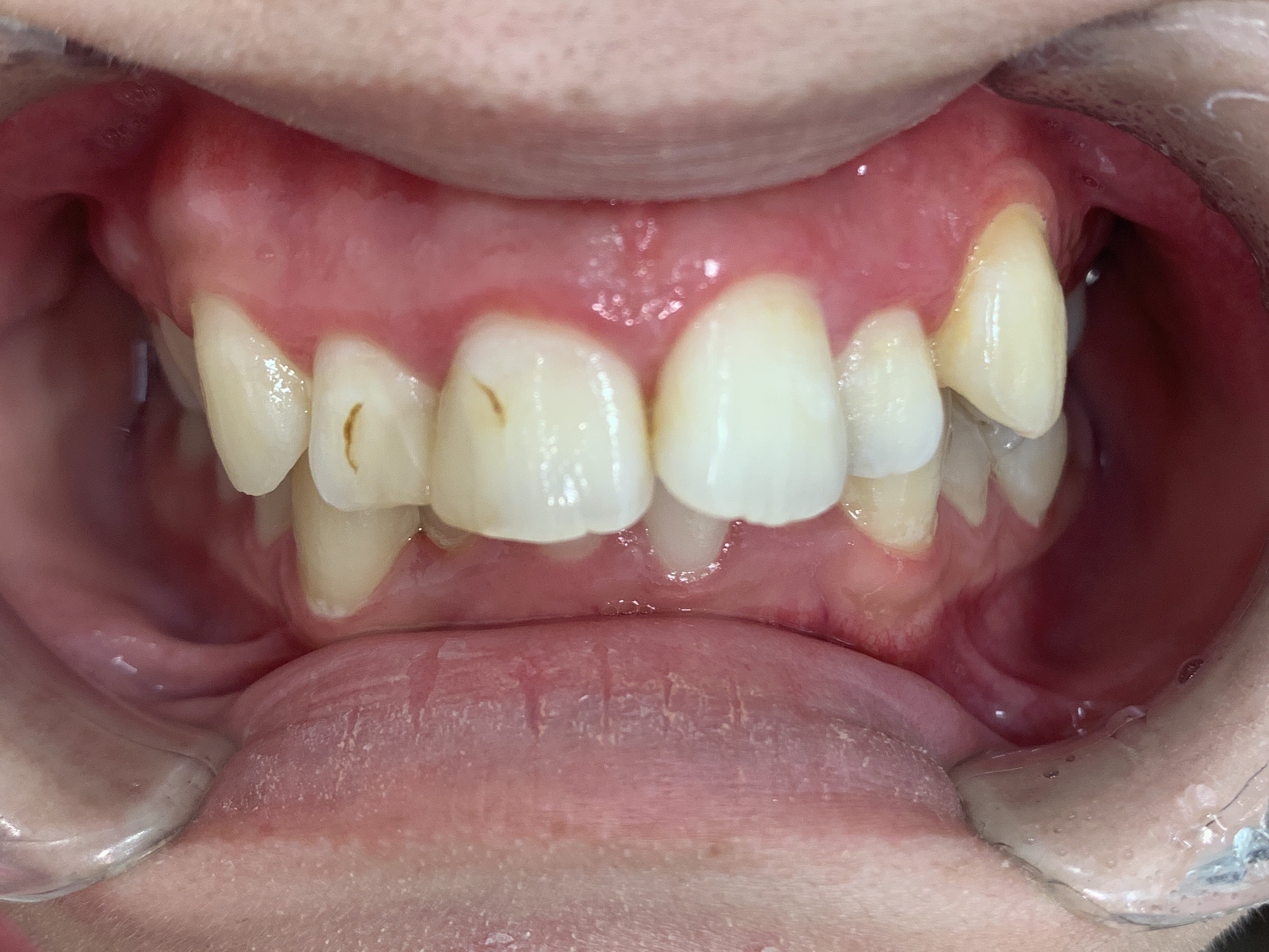 インビザラインGO治療 症例