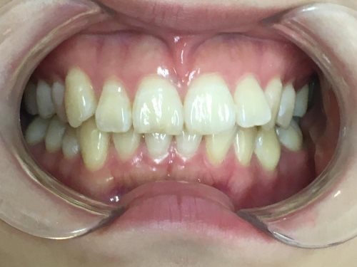 インビザライン治療 症例