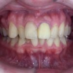 インビザラインＧO治療　症例