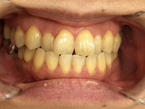 インビザライン治療　症例