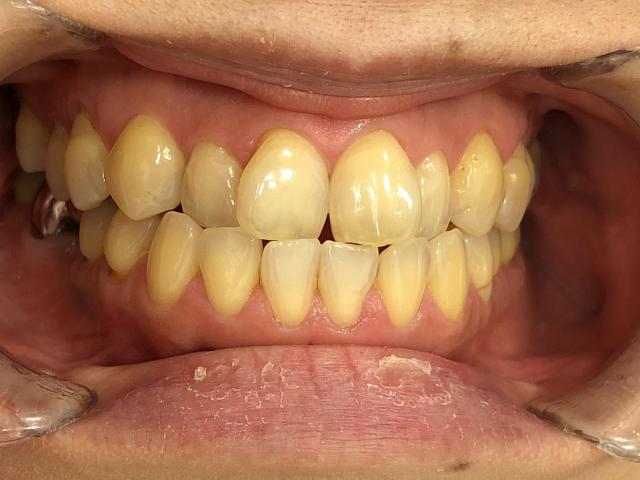 インビザライン治療　症例