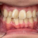 インビザライン治療　症例