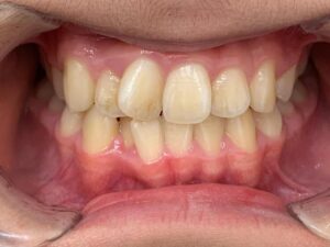 インビザライン治療　症例